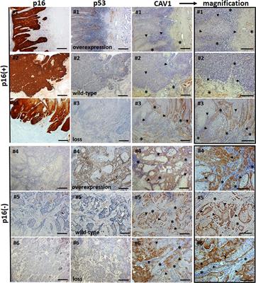 The Biomarker Potential of Caveolin-1 in Penile Cancer